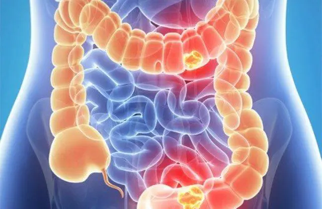 Tumore al colon retto: allarme screening