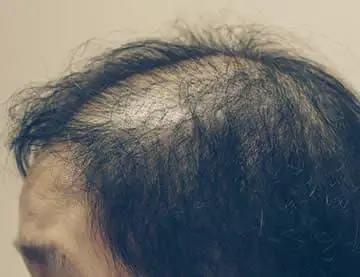 Innovativa terapia Ritlecitinib promette risultati eccezionali per pazienti con alopecia