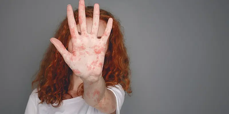 Aumento dei casi di morbillo in Italia: adolescenti e adulti tra più colpiti